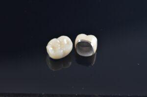 porcelain fused to metal